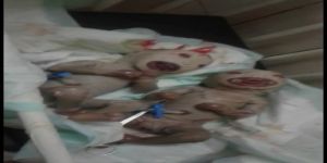 بالصور.. مستشفي شهير في السودان يشهد اغرب حالة ولادة توأم في شكل ألعاب صناعية