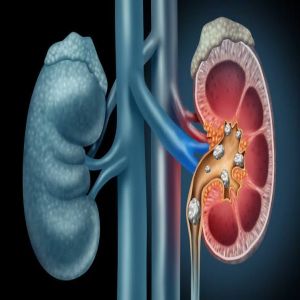 بينها خل التفاح.. 5 علاجات طبيعية لحصوات الكلى