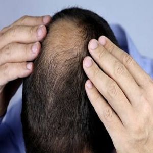 اكتشاف طبيعي رائد لعلاج تساقط الشعر والصلع الوراثي