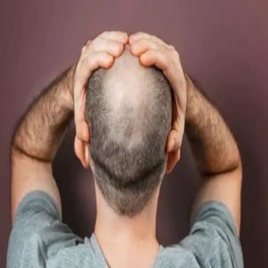 سيدة تقاضي زوجها لإخفاء صلعه عنها